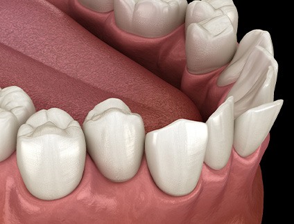 Illustration of crooked teeth