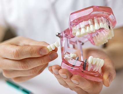 Dentist showing patient model of implant bridge
