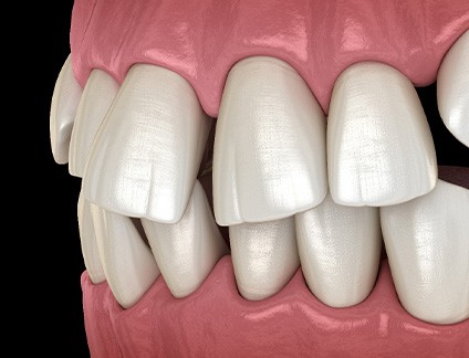 Illustration of gapped teeth