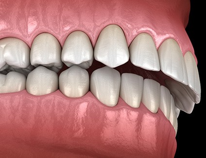 Illustration of an overbite