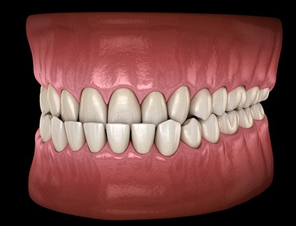 Illustration of an underbite