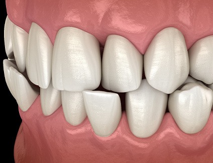 Illustration of a crossbite