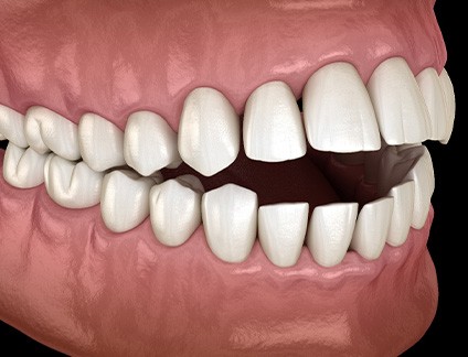 Illustration of an open bite