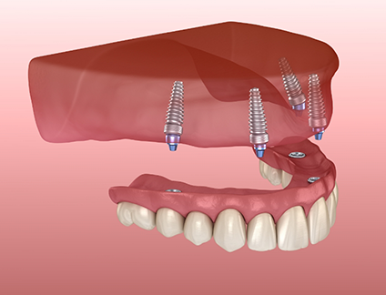 Dentist explaining an All-on-4 dental implant treatment plan to a patient