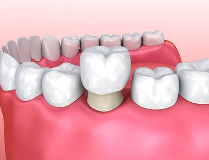 Illustration of a dental crown being placed on a tooth